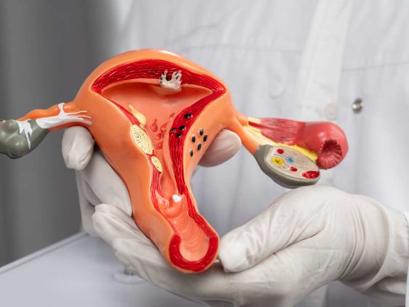 Glifo para Hidrosalpinx : lo que debes saber antes de un programa de FIV