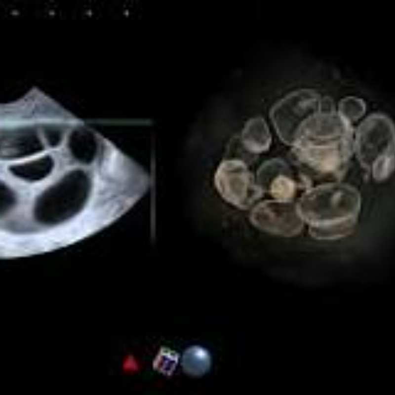 Comprensione della bassa riserva ovarica: un'analisi completa
