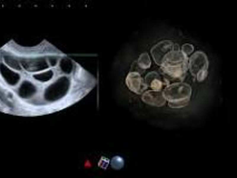 Comprensione della bassa riserva ovarica: un'analisi completa
