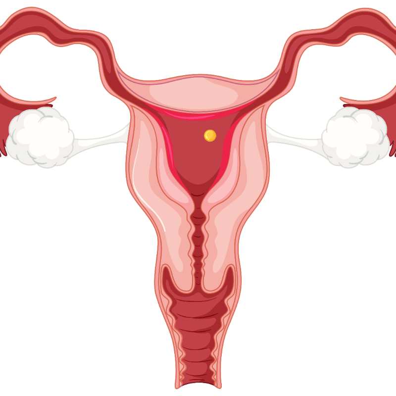 Qu'est-ce que la salpingectomie et puis-je tomber enceinte après cette intervention ?